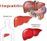 Cara Ampuh Mengobati Hepatitis Ala Herbal